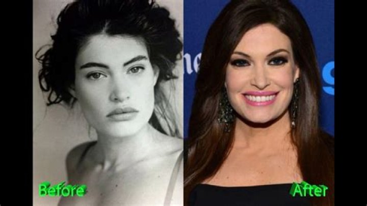 Kimberly Guilfoyle Surgery: The Journey of Transformation and Resilience
