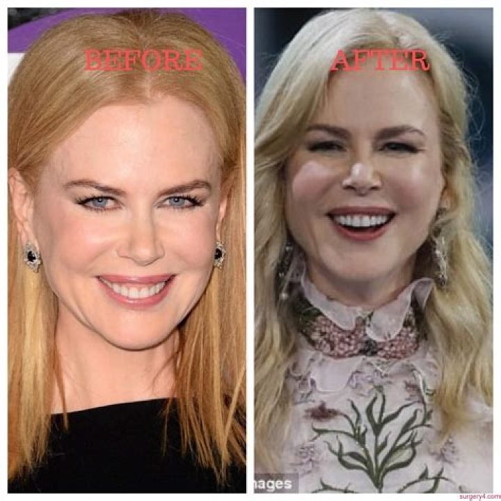 Nicole Kidman Plastic Surgery: A Comprehensive Look at Her Transformation and Choices